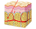 Laser Subcision