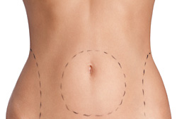 Lipolaser
